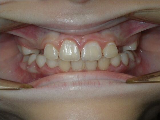 Orthodontic treatment in Phases: Case 10 - After