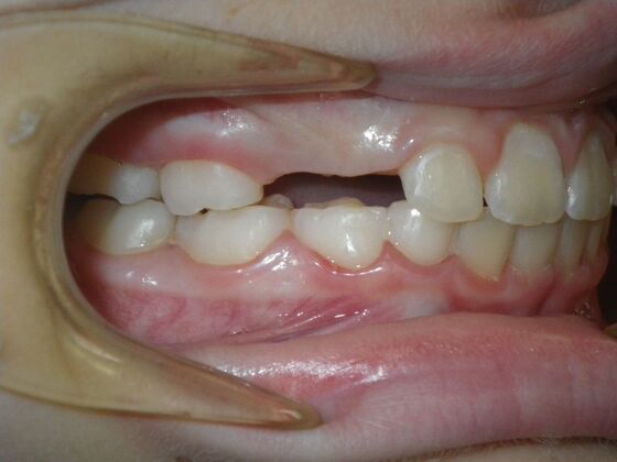 Orthodontic treatment in Phases: Case 10 - After
