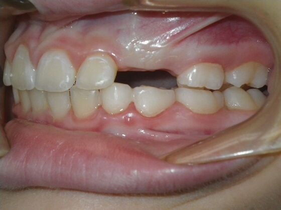 Orthodontic treatment in Phases: Case 10 - After