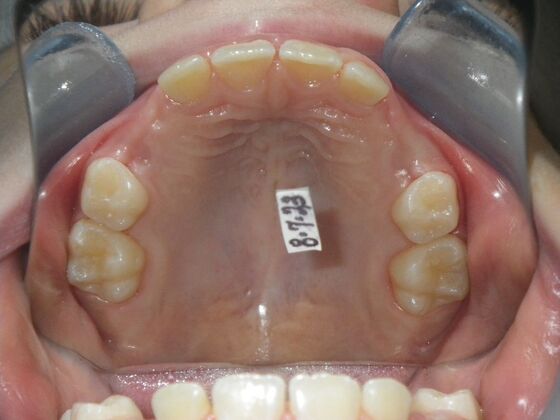 Orthodontic treatment in Phases: Case 10 - After