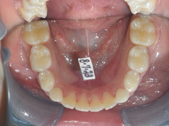 Orthodontic treatment in Phases: Case 10 - After