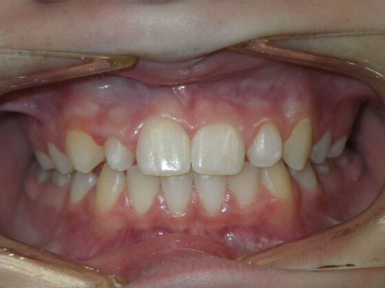 Orthodontics: Case 41 - Before
