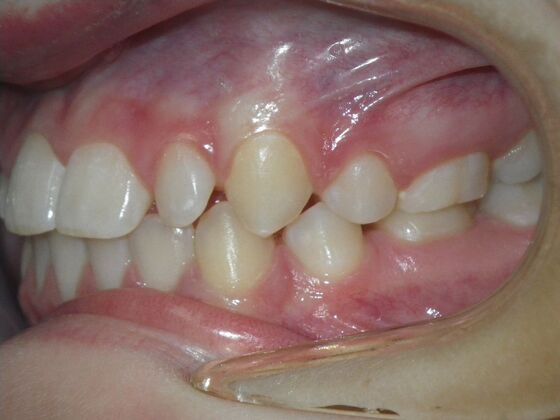 Orthodontics: Case 41 - Before