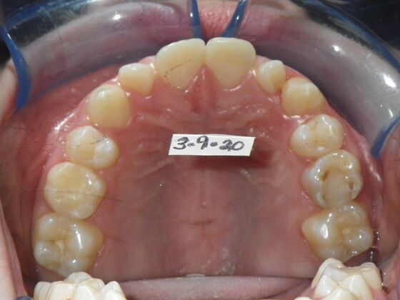 Orthodontics: Case 41 - Before