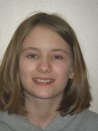 Orthodontics Case 42 - Before