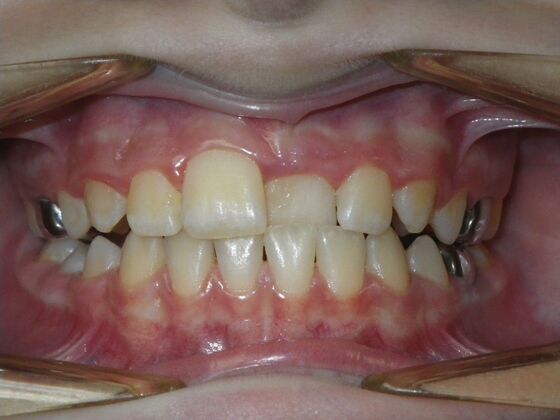 Orthodontics: Case 42 - Before