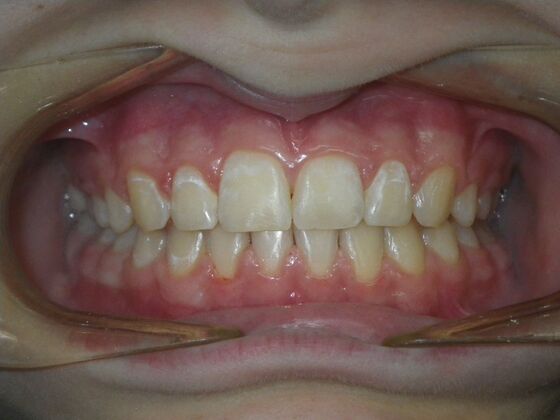 Orthodontics: Case 42 - After