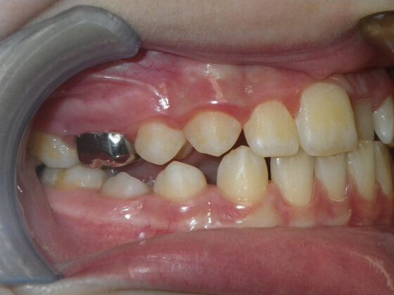 Orthodontics: Case 42 - Before