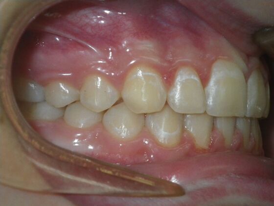 Orthodontics: Case 42 - After