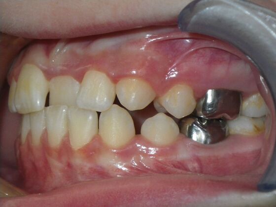 Orthodontics: Case 42 - Before