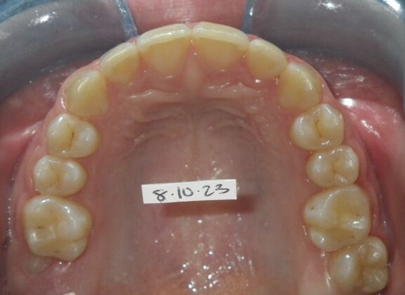 Orthodontics: Case 42 - After