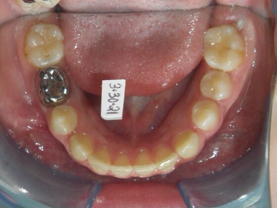 Orthodontics: Case 42 - Before