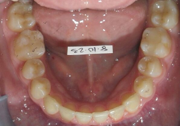 Orthodontics: Case 42 - After