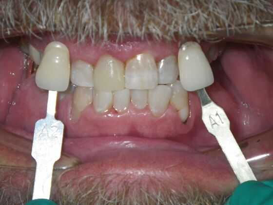 In-Office Zoom Whitening: Case 5 - After