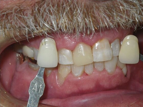 In-Office Zoom Whitening: Case 5 - After
