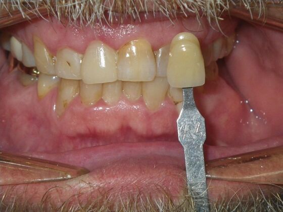 In-Office Zoom Whitening: Case 5 - Before