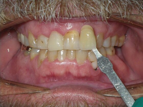 In-Office Zoom Whitening: Case 5 - Before