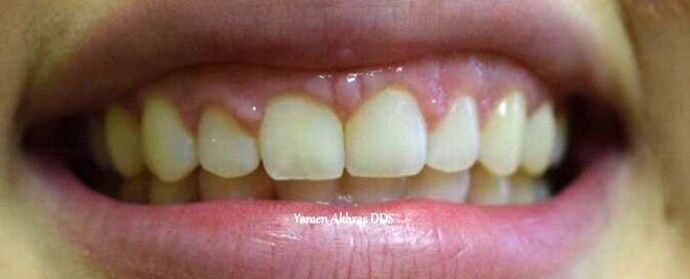 Braces Patient 1 - After