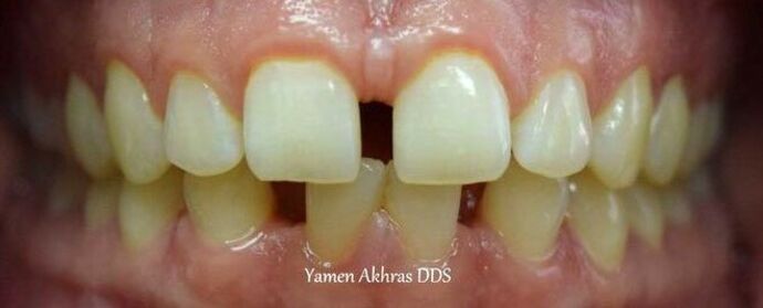 Braces Patient 1 - Before