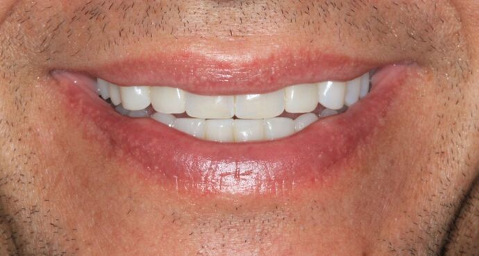 Invisalign: Case 21 - After
