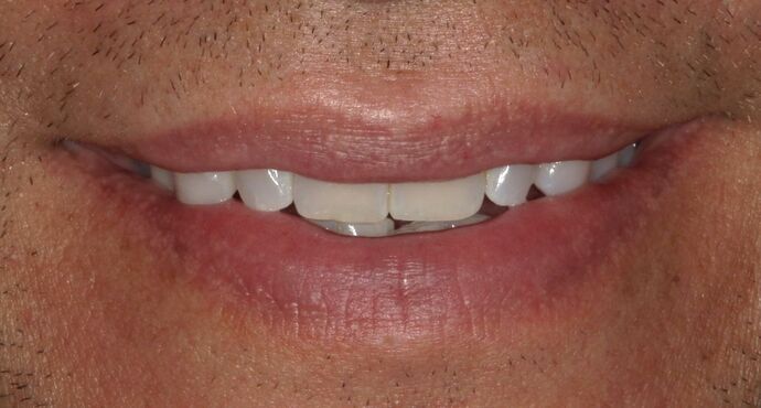 Invisalign: Case 21 - Before