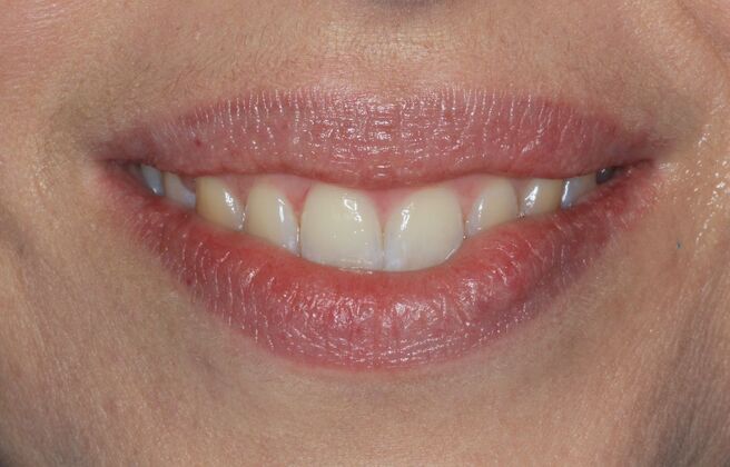 Invisalign Case 22 - Before