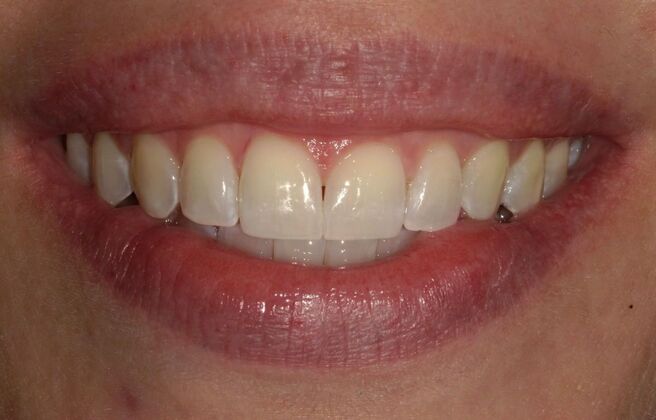 Invisalign Case 22 - After