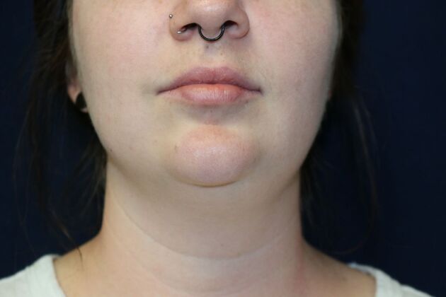 Neck Sculpting : Case 3 - Before