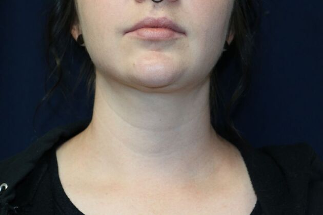 Neck Sculpting : Case 3 - After