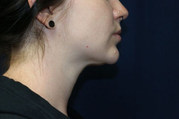 Neck Sculpting : Case 3 - After