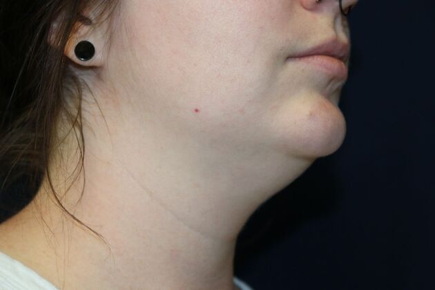 Neck Sculpting : Case 3 - Before