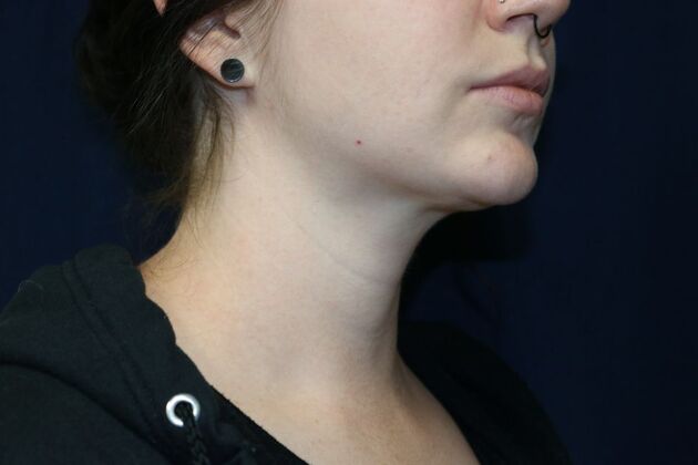 Neck Sculpting : Case 3 - After