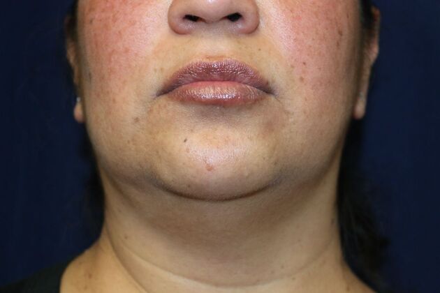 Neck Sculpting : Case 8 - Before