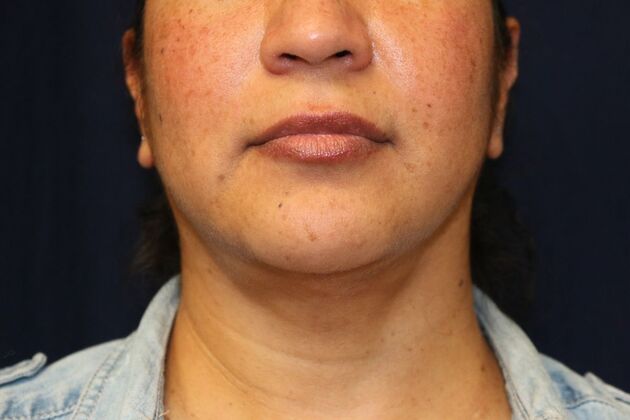 Neck Sculpting : Case 8 - After