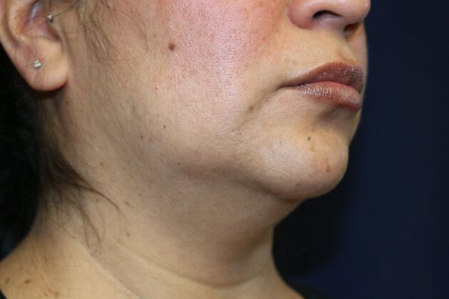 Neck Sculpting : Case 8 - Before