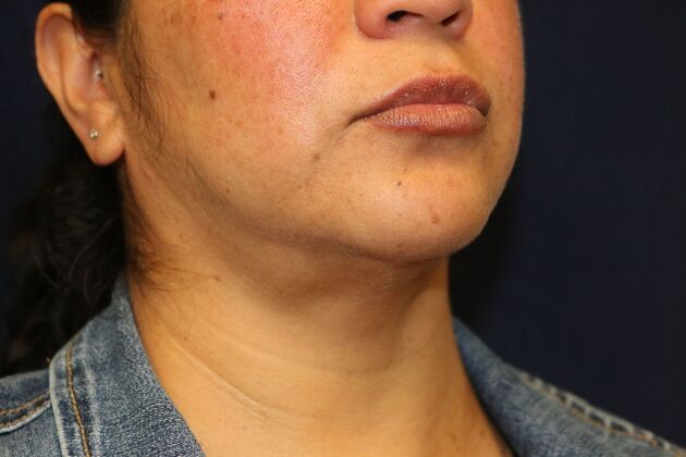 Neck Sculpting : Case 8 - After