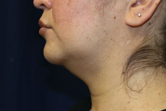 Neck Sculpting : Case 8 - Before