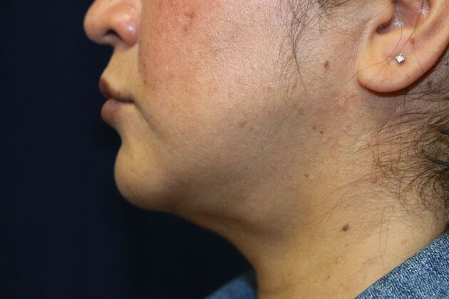 Neck Sculpting : Case 8 - After