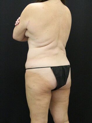 Liposuction: Case 26 - After