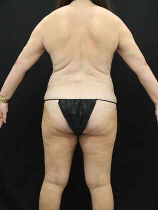 Liposuction: Case 26 - After