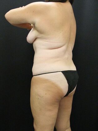 Liposuction: Case 26 - Before
