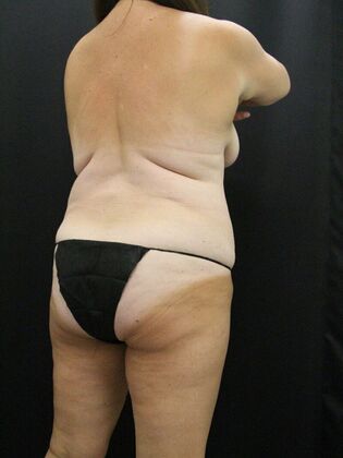 Liposuction: Case 26 - Before