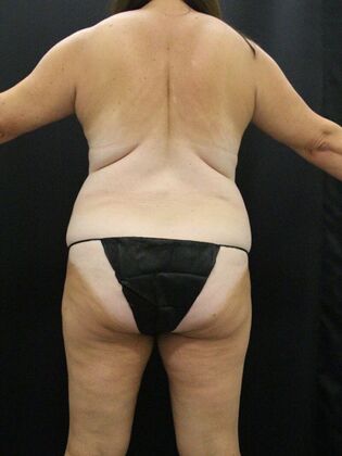 Liposuction: Case 26 - Before
