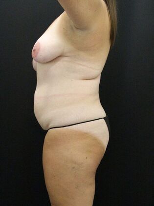 Liposuction: Case 26 - Before