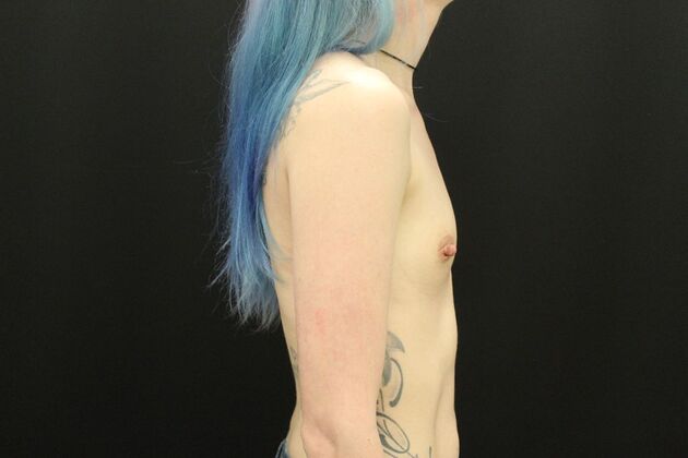 Breast Augmentation: Case 81 - Before