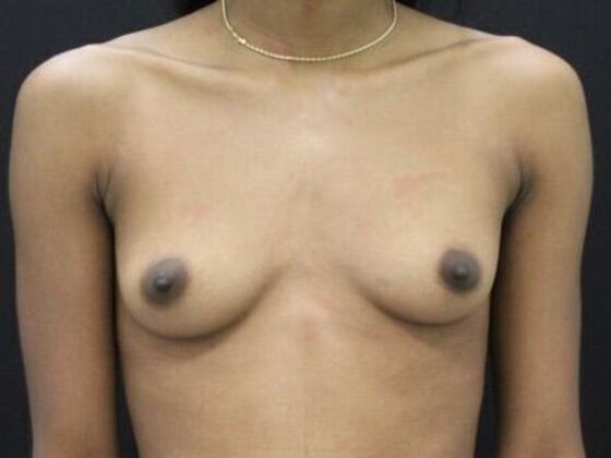 Breast Augmentation: Case 82 - Before
