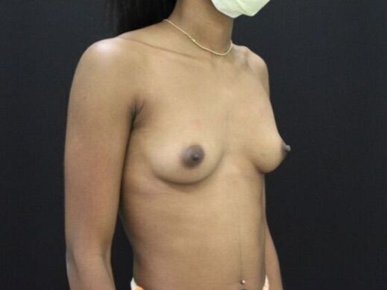Breast Augmentation: Case 82 - Before