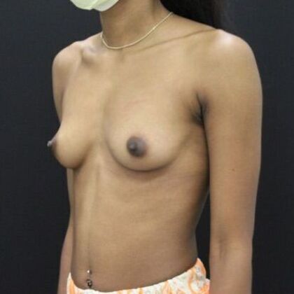 Breast Augmentation: Case 82 - Before