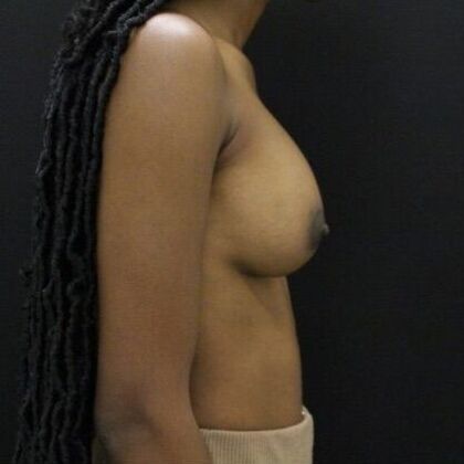 Breast Augmentation Case 82 - After