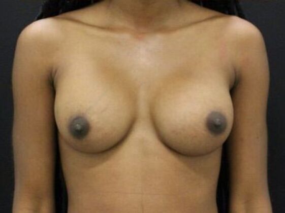 Breast Augmentation: Case 82 - After